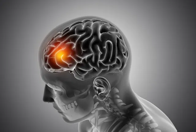Brain Tumor Surgery in Indore by Dr. Ashish Kumar Dwivedi