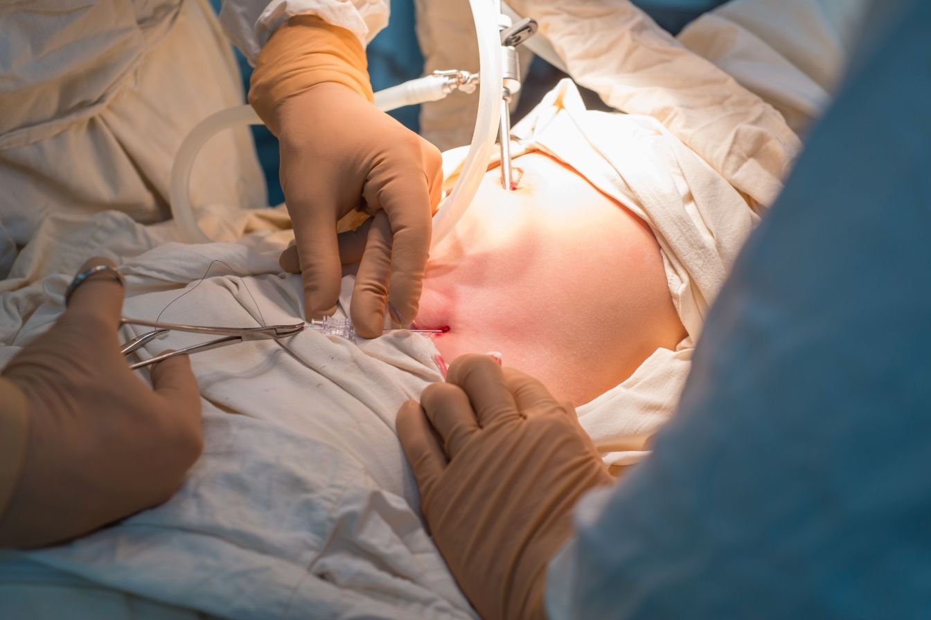 Endoscopic Spine Surgery