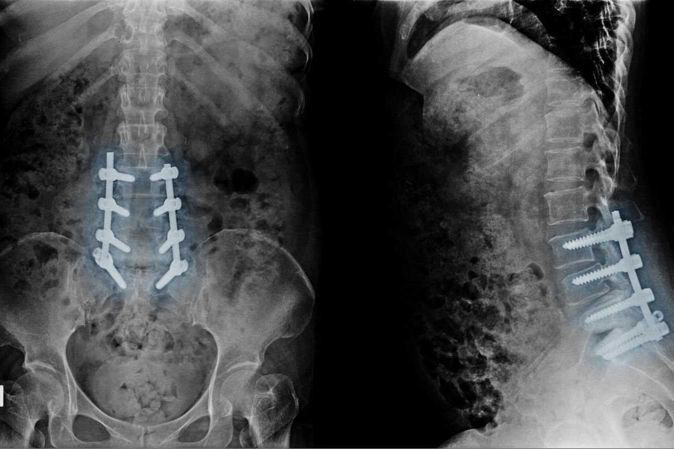 Lumbar Microdiscectomy